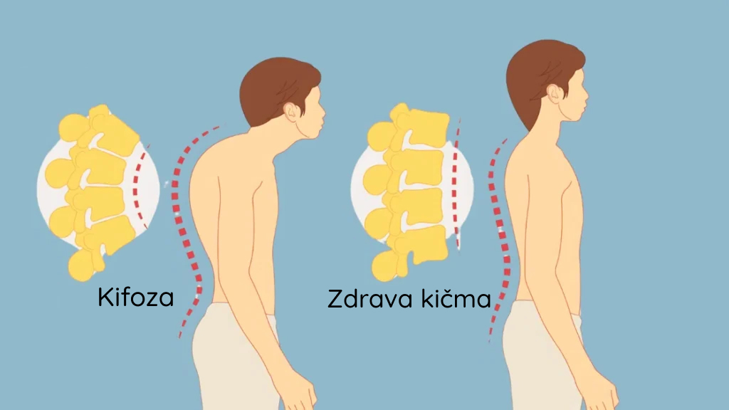Šta je kifoza?