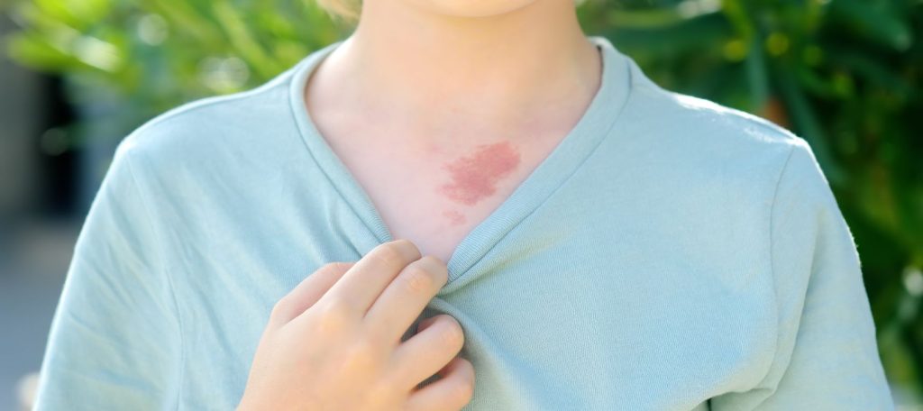 Kako izgleda ekcem kod dece - Prime Medical Kids