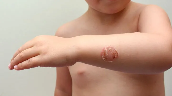 Impetigo kod dece - Kako izgleda i šta raditi?