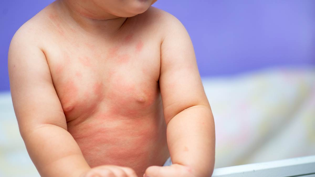 Infektivni eritem kod dece - Prime Medical Kids