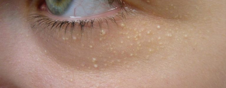 Milije (Mlečne Tačkice) kod Beba