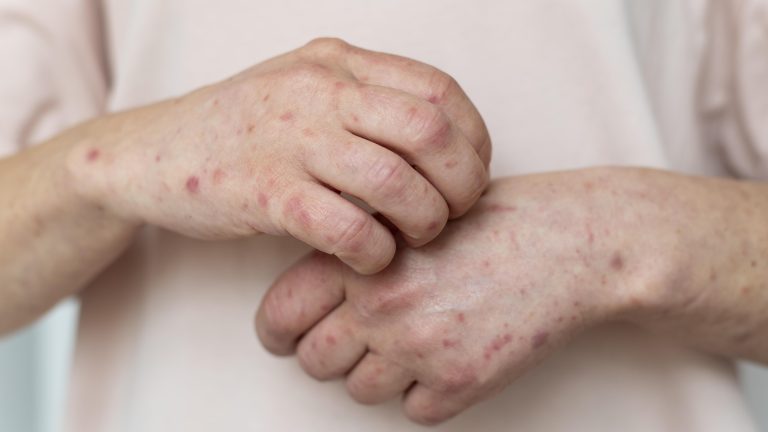 Šuga kod dece - Prime Medical Kids