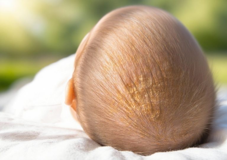 Temenjača kod dece - Kako izgleda - Prime Medical Kids