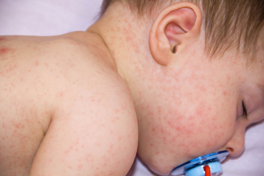 alergija-kod-beba-mleko