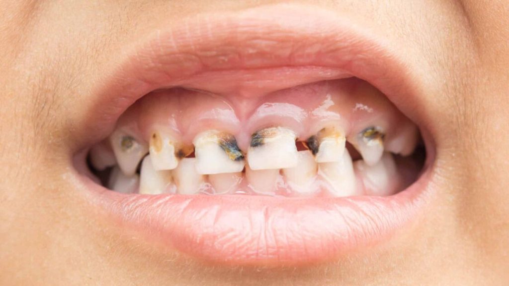 Pokvareni mlečni zubi kod dece