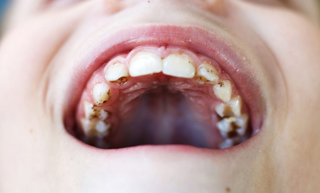 Pokvareni zubi kod dece