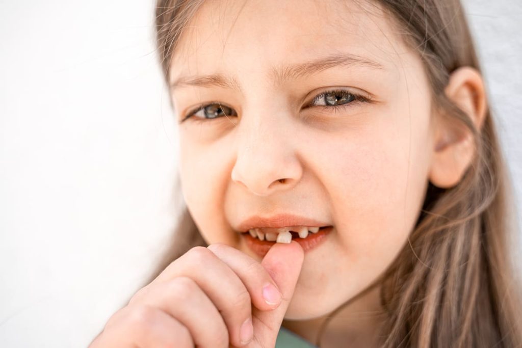 Pokvareni zubi kod dece - kako uočiti karijes kod dece