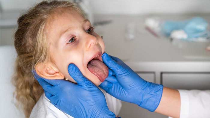 Gnojna Angina kod Dece [Simptomi, Lečenje i Prevencija]