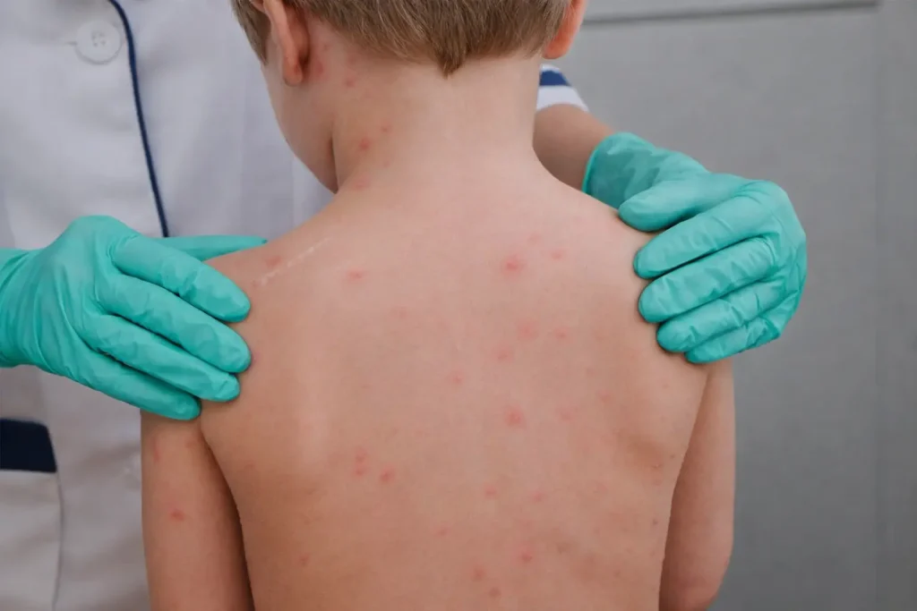 Boginje kod dece: Kada su opasne? Ovčije boginje