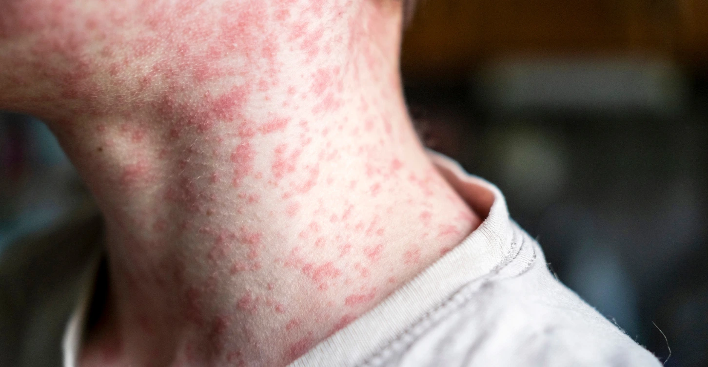 boginje kod dece measles