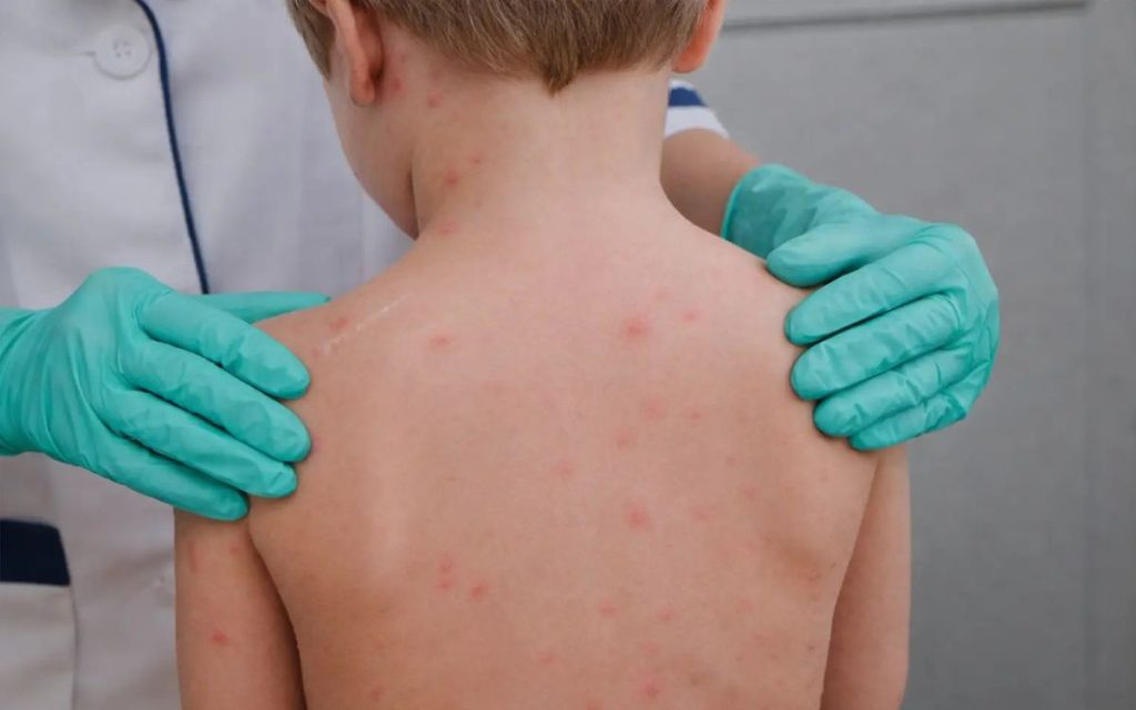 Boginje kod dece: Kada su opasne?