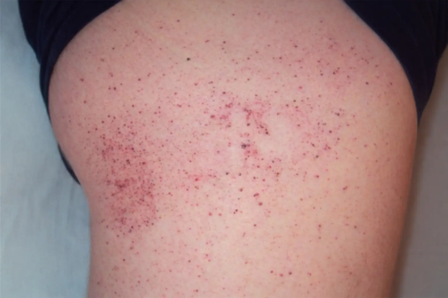 Fabrijeva Bolest kod Dece - Prime Medical Kids