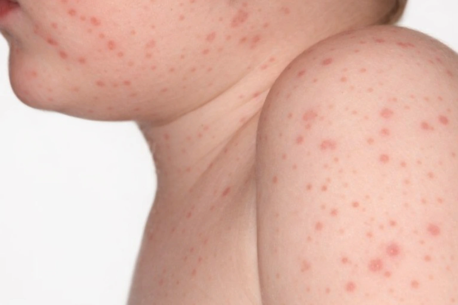 Male Boginje kod Dece Slike