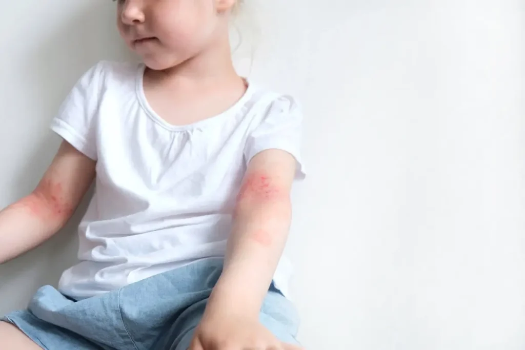 Atopijski dermatitis kod dece: na rukama, na licu, na telu