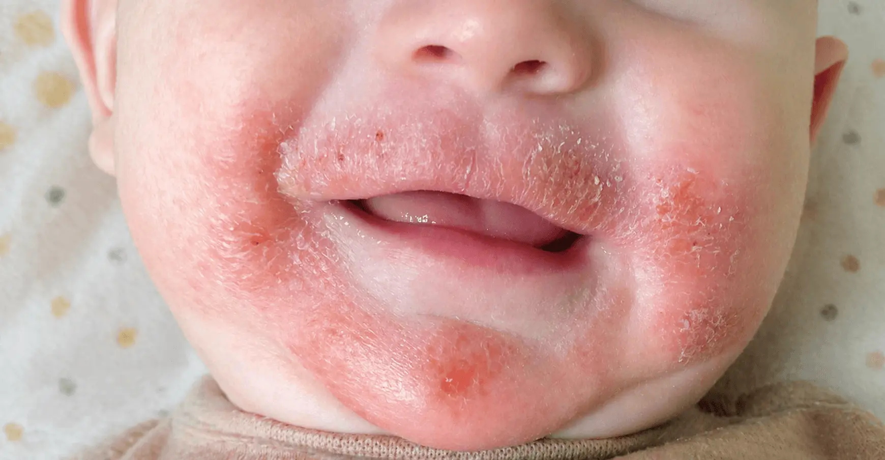 Atopijski dermatitis kod dece na licu