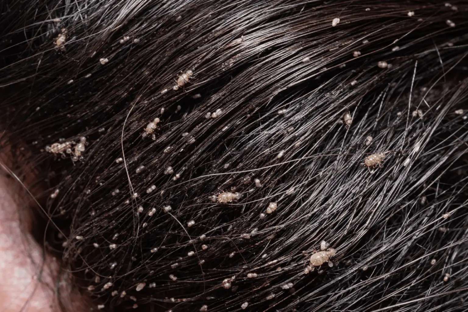 Vaške u kosi - izgled, slike