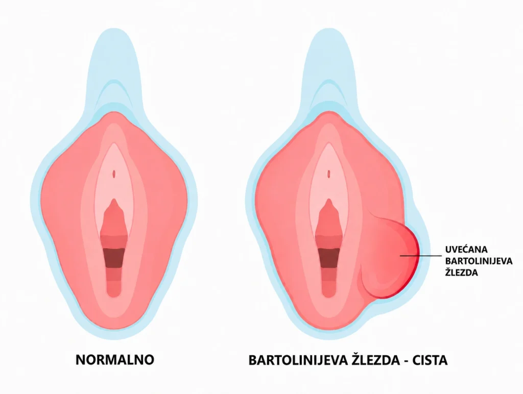 Bartolinijeva žlezda - Uvećana bartolinijeva žlezda (cista)